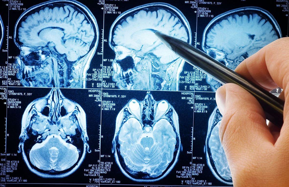 Avanços na Cirurgia de Tumores Cerebrais- GLIOLAN (ácido 5-aminolevulínico)