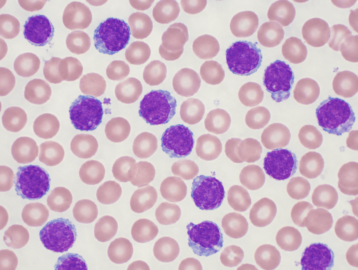 Zanubrutinibe: conheça o medicamento BRUKINSA para leucemia e linfomas