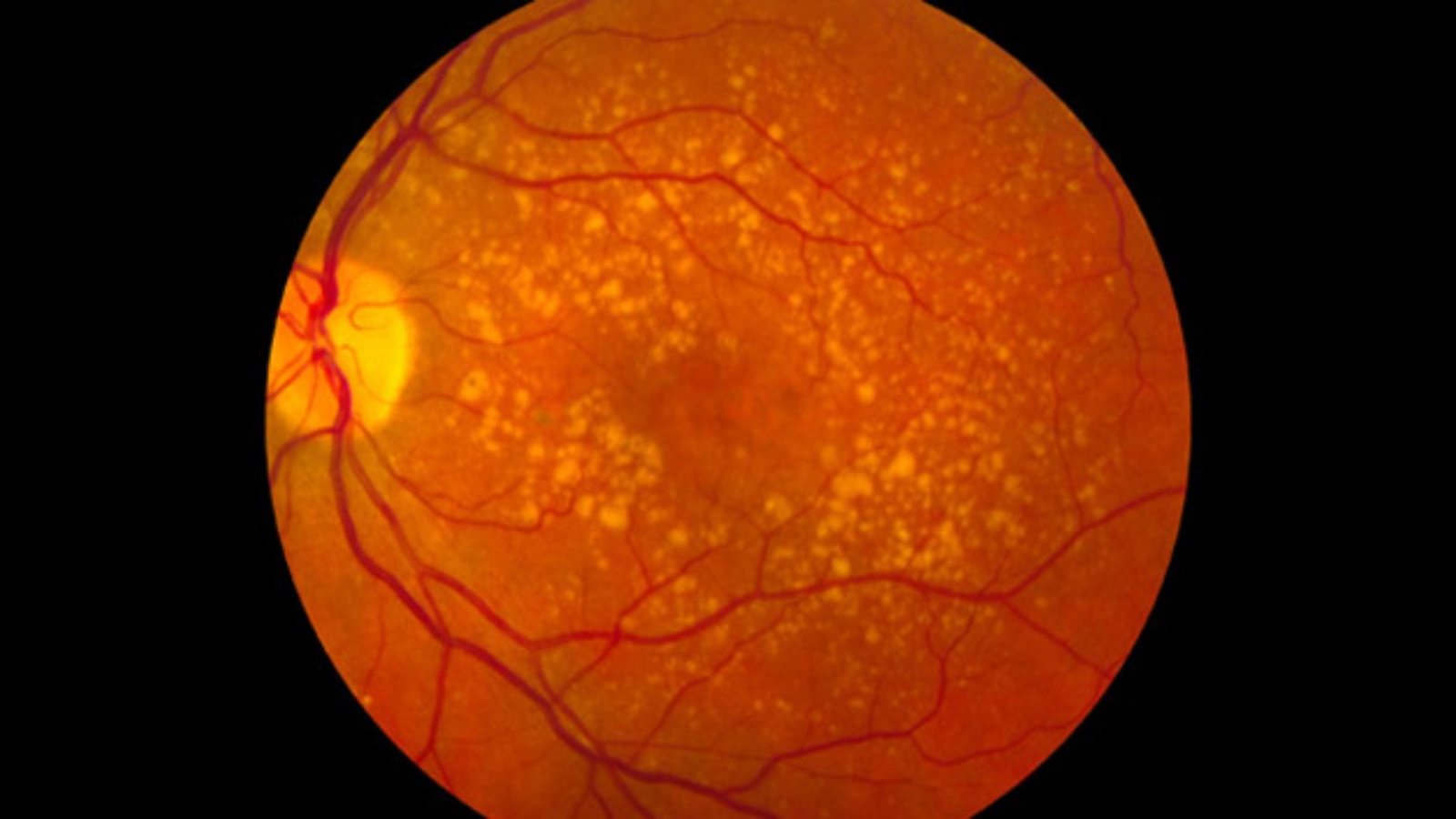 Terapia fotodinâmica e o VISUDYNE